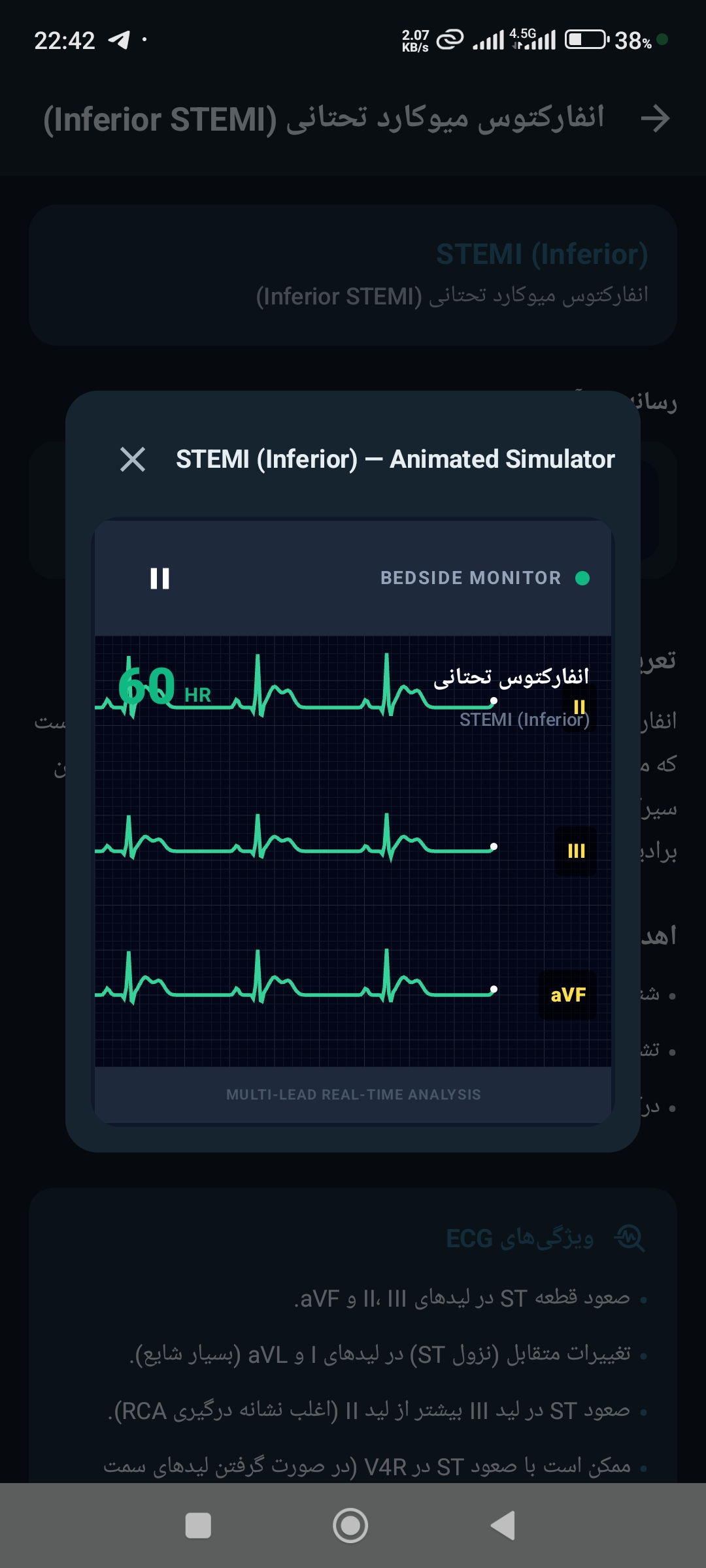 تحلیل ECG و شبیه‌ساز